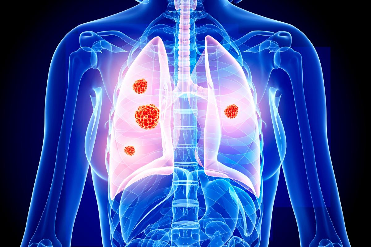 اكتشاف بروتين قادر على إيقاف سرطان الرئة