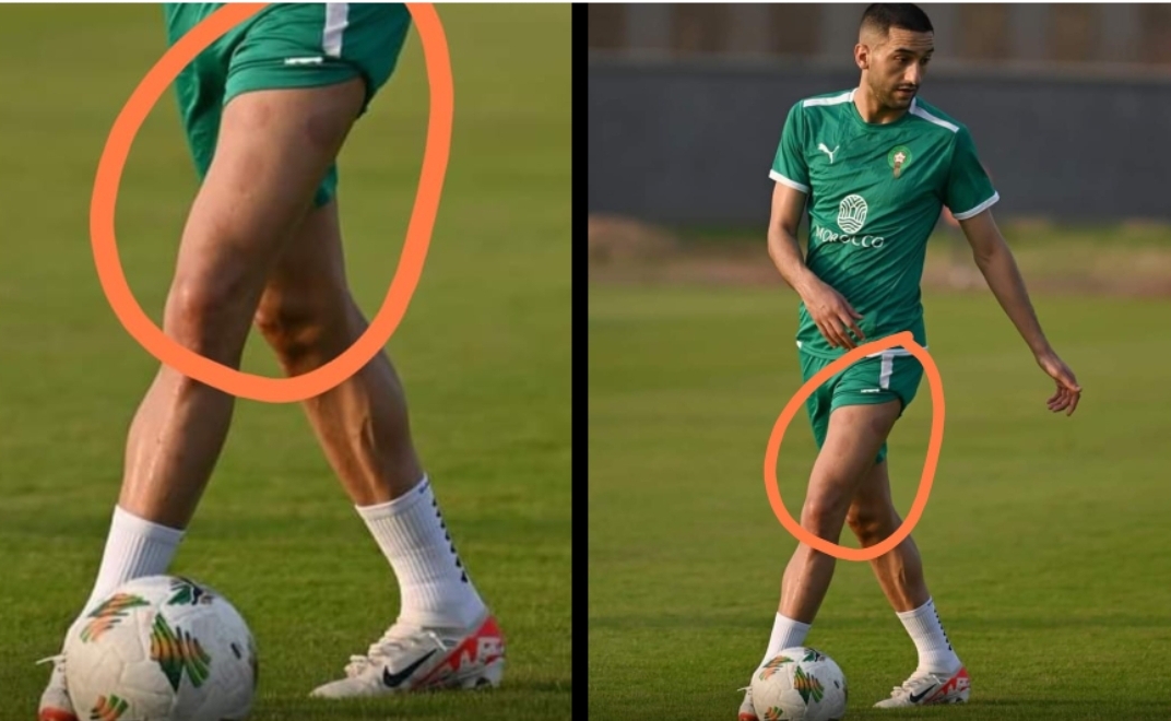 زياش يستعين بالطب النبوي لعلاج إصابته قبل مباراة الغد ضد تنزانيا