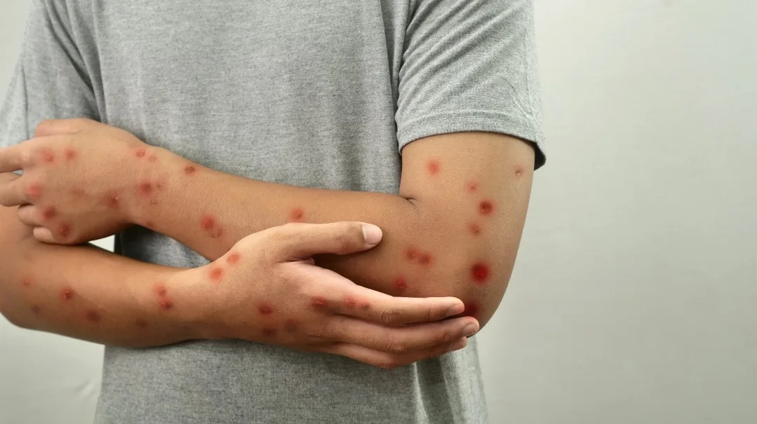 إنتشار مخيف لمرض “بوحمرون” بإقليم شفشاون