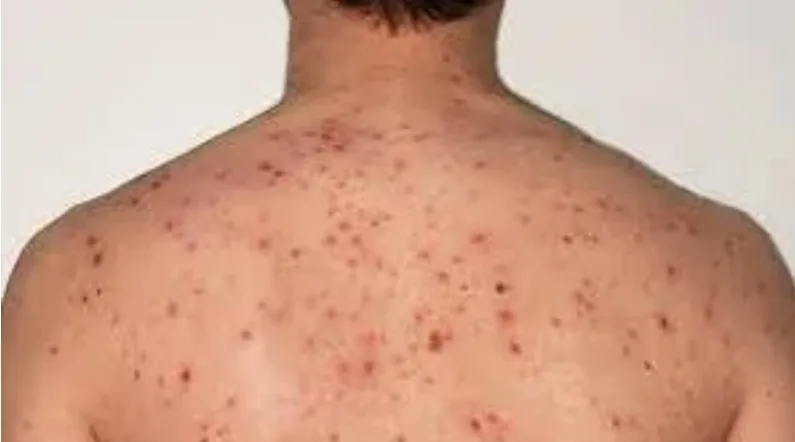 وفاة شاب بجرسيف بسبب بوحمرون واستنفار صحي لمتابعة أشقائه