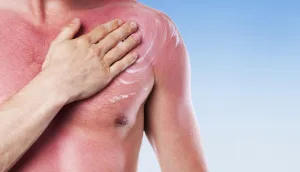 “جل في الحقنة” ابتكار سويدي يعد بثورة في علاج الحروق وإعادة بناء الجلد