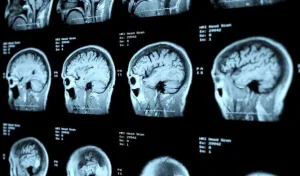 “كل دقيقة لها أهميتها”… المغرب يطلق حملة وطنية للوقاية من السكتة الدماغية