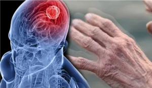 بعد دواء السرطان … روسيا تعلن إكتشافها علاج لمرض باركنسون