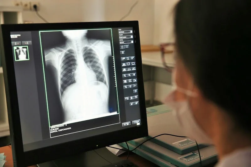 أشكال السل خارج الرئة تمثل أكثر من نصف الحالات الجديدة بالمغرب