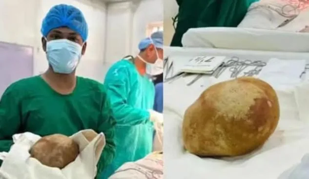 بحجم بيضة نعامة … أطباء سريلانكيون يستخرجون حصاة بولية ضخمة تزن 3.1 كيلوغرام من مثانة رجل